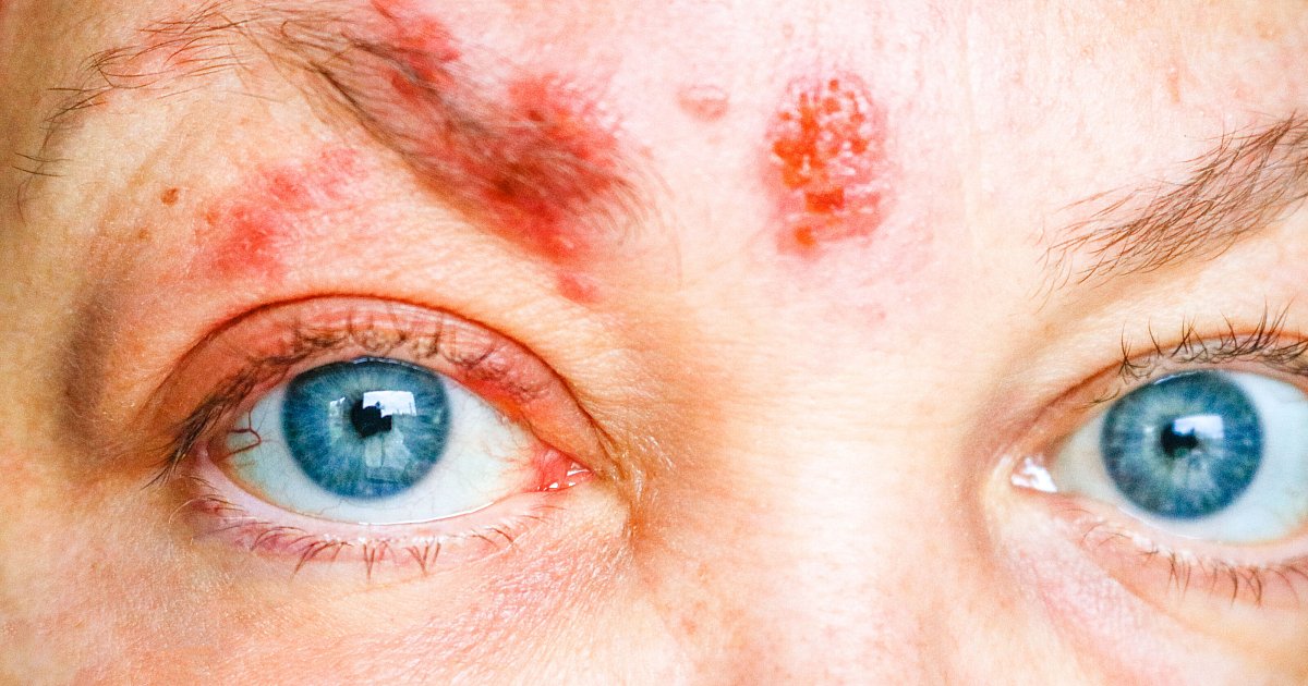 -Wie-Ameisen-im-Kopf-Lipperin-erlebt-seit-einer-G-rtelrose-schlimmste-Qualen