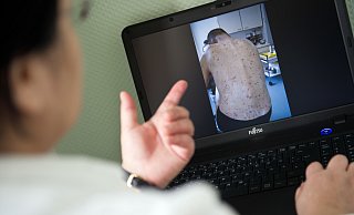 Wenn Krätzmilben nicht behandelt werden, breitet sich der Parasit weiter aus. - Daniel Naupold/dpa