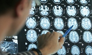 Ein Arzt zeigt auf die CT-Aufnahmen einer jungen Schlaganfallpatientin. Jeder fünfte Patient ist jünger als 55 Jahre. - picture-alliance