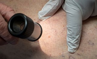 Die Zahl der Krankenhausbehandlungen von Hautkrebs stieg enorm an. (Symbolbild) - Peter Kneffel/dpa