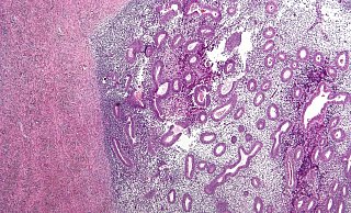 So sieht eine Endometriose unter dem Mikroskop aus. - Wikipedia