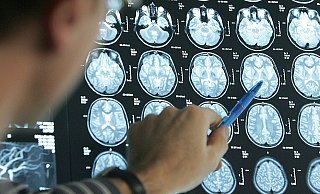 Ein Arzt zeigt auf die CT-Aufnahmen eines Schlaganfallpatienten. Jeder fünfte Patient ist jünger als 55 Jahre. - Symbolfoto: Picture Aliance