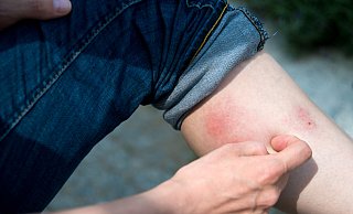 Mückenstiche lösen Juckreiz aus, richtig schmerzhaft ist der Stich einer Hornisse. Gefährlich wird es jedoch, wenn Bakterien eingeschleppt wurden. - picture alliance / dpa-tmn