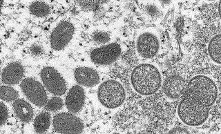 Im Kreis Höxter ist der erste Fall von Affenpocken nachgewiesen. - Cynthia S. Goldsmith/Russell Regner/CDC/AP/dpa