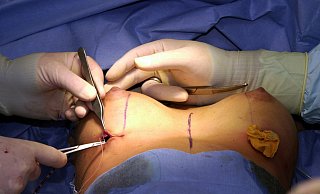 Am 15. Januar 2014 unterzog sich eine Bad Oeynhausenerin am Klinikum Herford aufgrund eines Tumors in einer Brust einer Operation. Die Ärzte entschieden sich gegen eine radikale Brustamputation. Das hatte schwerwiegende Folgen für die Patientin. - dpa