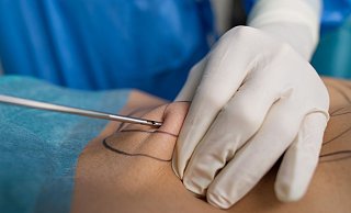 Unter bestimmten Voraussetzungen trägt die gesetzliche Krankenversicherung künftig die Kosten für eine Liposuktion. - Uwe Anspach/dpa-tmn