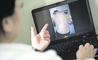 Das Foto zeigt einen an Krätze erkrankten Patienten. Die Milben bohren sich unter die Haut.  - picture alliance / dpa