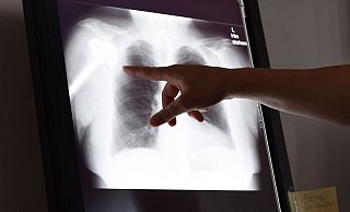 Über die Landesärztekammern kann man ein kostenloses Verfahren bei Gutachterkommissionen und Schlichtungsstellen einleiten, die eine ärztliche und juristische Bewertung des Falls vornehmen. - Susann Prautsch/dpa/dpa-tmn