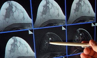 Bei einer Mammographie wird die Brust der Frau untersucht. - Picture Alliance