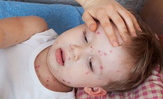 Windpocken können sehr gefährlich werden. - AOK