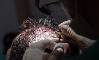 Unter bestimmten Voraussetzungen können die Kosten einer Haartransplantation steuerlich geltend gemacht werden. - Andrea Warnecke/dpa-tmn