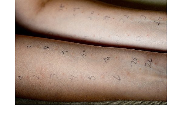So sehen die Arme eines Patienten bei einem Pricktest aus. - © dpa