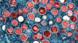 Mehr Fälle von Mpox - aber Experte bislang gelassen