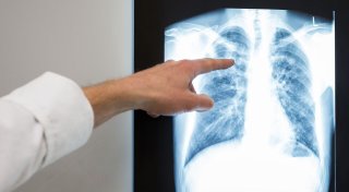 Kampf gegen Tuberkulose zeigt Wirkung - aber mehr Geld nötig