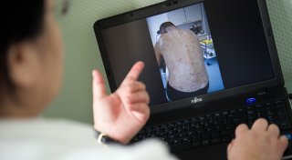 Krätze im Kreis Herford auf dem Vormarsch: Schutz gegen die Parasiten kaum möglich
