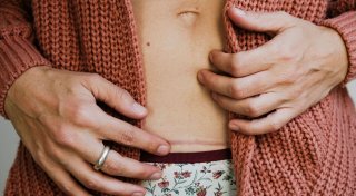 Worauf es bei der Pflege von Narben ankommt