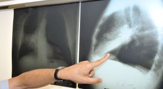 Lungenkrebs-Früherkennung für starke Raucher kommt