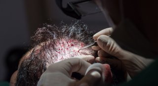 Wann Haartransplantationen steuerlich absetzbar sind
