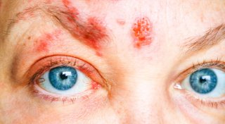 „Wie Ameisen im Kopf“: Lipperin erlebt seit einer Gürtelrose schlimmste Qualen