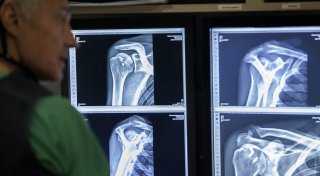 Wenn Niesen zu Knochenbrüchen führt: 205.000 Menschen leiden in Westfalen an Osteoporose