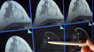 Mammografie-Screening senkt Brustkrebs-Sterblichkeit