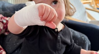 Brandwunden im Advent: So geht Erste Hilfe