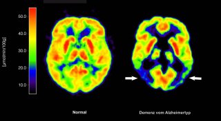 Antikörper Lecanemab: Wie er wirkt und wem er helfen kann