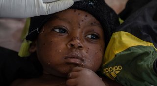 WHO gibt grünes Licht für schnelleren Mpox-Test