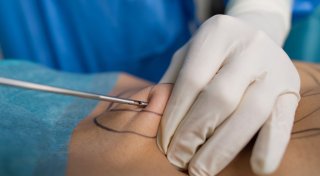 Kasse zahlt Lipödem-OP: Was das für Patientinnen bedeutet