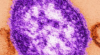 Höchste Masernzahl in Europa und Zentralasien seit 27 Jahren