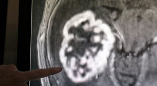 Herzschwäche, Alzheimer, Krebs: microRNA in der Medizin