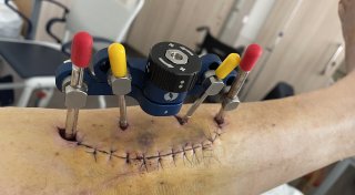 Simulierter Knochenbruch hilft Patienten aus Herford bei Wundheilung eines diabetischen Fußes