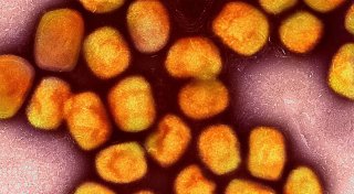 Erster Fall der neuen Mpox-Variante in Deutschland
