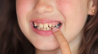 Besorgniserregend: Jeder vierte Erstklässler im Kreis Herford hat bereits Zahnfüllungen