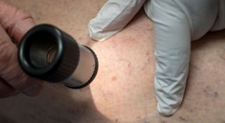 Wesentlich mehr in Kliniken behandelte Hautkrebsfälle
