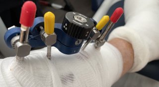 Knochenbruch hilft Herforder bei Wundheilung eines diabetischen Fußes