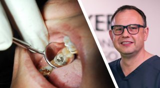 Amalgam-Verbot bei Zahnfüllung: Das ändert sich 2025 für Mindener Patienten