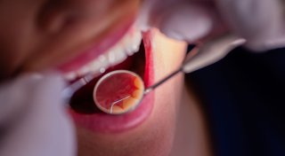 Keine Amalgam-Füllungen mehr: Was die Kasse zahlt