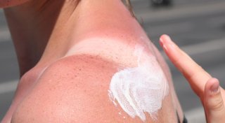 Knallrot und mit Blasen: Was hilft bei starkem Sonnenbrand?