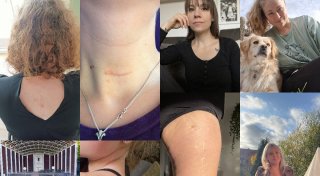 Verheilte Wunden: Warum diese vier Frauen aus Minden und Umgebung stolz auf ihre Narben sind