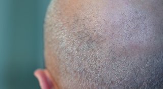Muss ich Mittel gegen Haarausfall aus eigener Tasche zahlen?