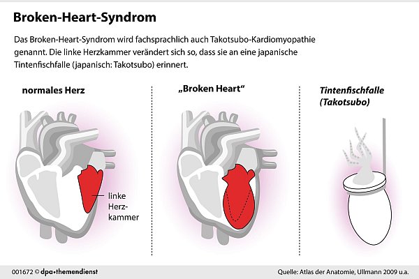 Das Broken-Heart-Syndrom erinnert an einen Herzinfarkt. Tatsächlich verändert sich dabei aber vor allem die linke Herzkammer. - © dpa-infografik/dpa-tmn
