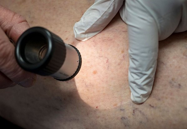 Wenn ein Muttermal seine Form oder Farbe ändert, sollte das von einem Arzt untersucht werden. - © Peter Kneffel/dpa