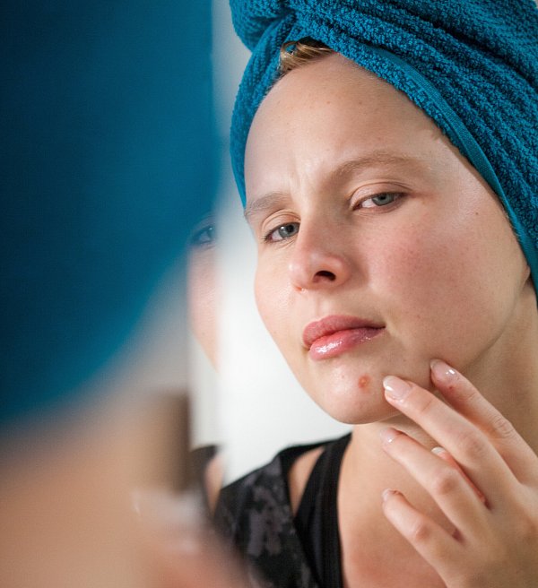 Vorsicht im Todesdreieck: Das Ausdrücken von Pickeln im Dreieck zwischen Nase und Mundwinkel kann ernsthafte gesundheitliche Risiken bergen. - © picture alliance / dpa Themendie