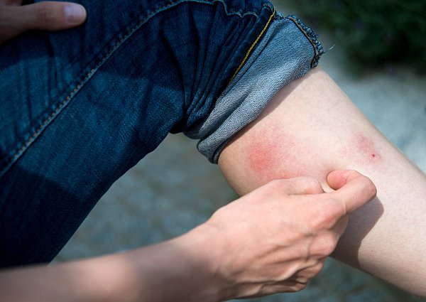 Wenn man doch von einer Falschen Witwe gebissen wurde, helfen einfache Schritte bei der Behandlung des Spinnenbisses. - © picture alliance / dpa-tmn